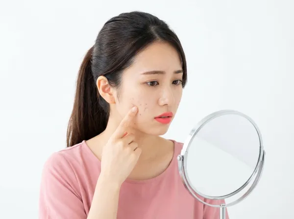 ニキビ跡にはレーザーが効くってマジ？！種類別おすすめ治療法を徹底解説