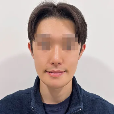 輪郭整形と鼻の手術を一緒に受けました！