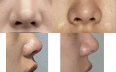 [**様] ほうれい線フィラー施術レビュー