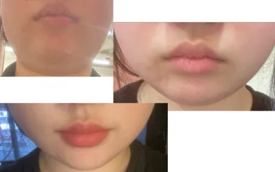 [**様] InMode+ビューティーフィット注射施術レビュー