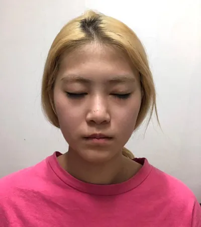 ジェイジュン美容外科で手術してから3ヶ月になりました!!