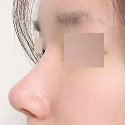 小さくへこんだハンプ切除手術後1ヶ月目のレビュー