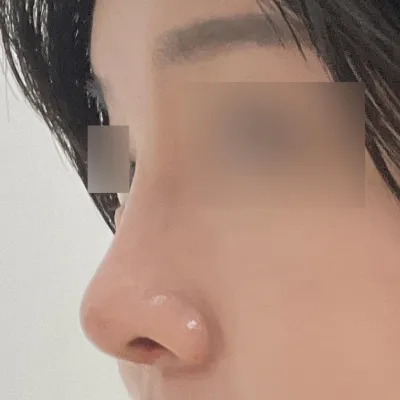 アップノーズ手術を受けました~! 