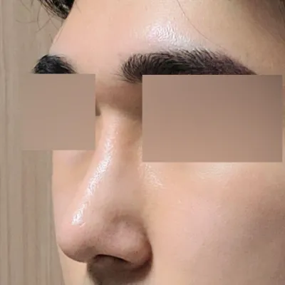 鼻の手術後1ヶ月目のレビューです