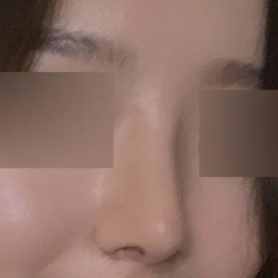 ウィーバースで手術してからついに2ヶ月になりました