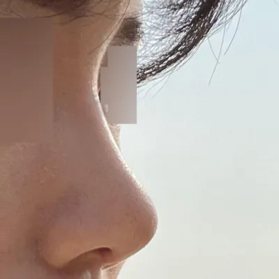 今日ついに内側の抜糸をしてきました！