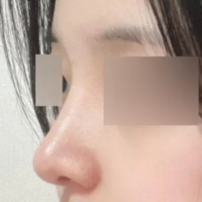 ウィバースで手術してから3ヶ月経ちました