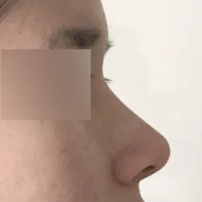 鼻の手術後3ヶ月目のレビュー！