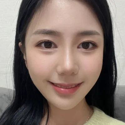 鼻整形、目の再手術から3ヶ月経ちました