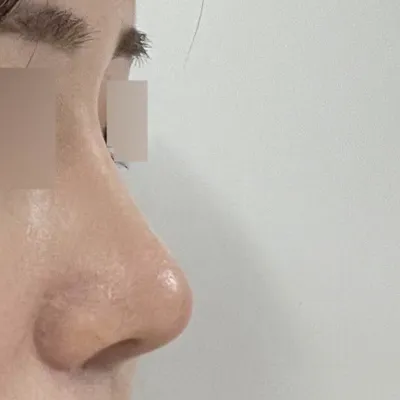 鼻の手術を受けてから3ヶ月になりました！