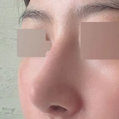 私の鼻を生まれ変わらせてくださったソ・スンジョ院長、ありがとうございます!