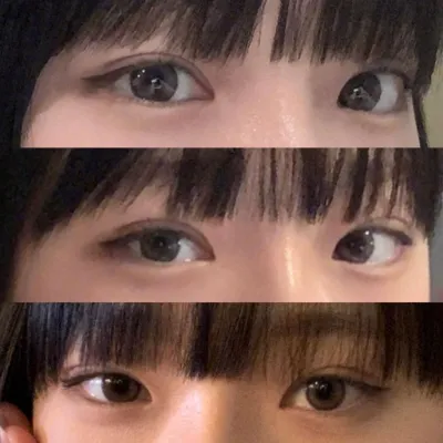 目の再手術、鼻の手術を受けました!