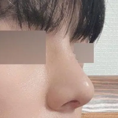 鼻炎手術兼、自己管理も兼ねて手術することになりました