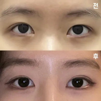 ウィーバース美容外科で手術して1ヶ月になりました~! 