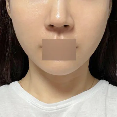 糸リフティング2週間目ですが、効果は本当にありますね！