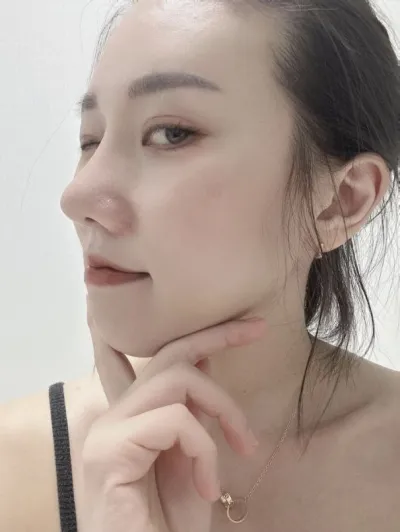 初めての鼻整形手術、この程度なら成功ではないでしょうか？