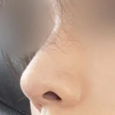 鼻整形をしたと思わなかったと言われるほど自然だと言われます。