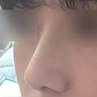 初めての鼻整形手術にもかかわらず、とてもとても3728299393829%満足しています