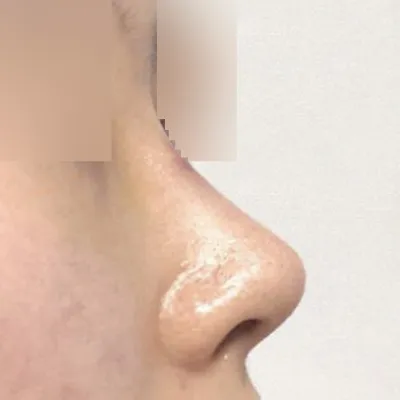 垂れた鼻先の手術を受けました